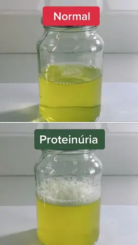 Normal Urine vs Protein in Urine (Proteinuria) #urinecolor #menhealth #bubblyurine #urineinfection #proteinuria #normalurine #foamyurine #urine #menhealth