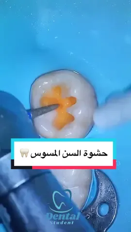حشوة السن المسوس 🦷✨ #طب #اسنان #طبيب_تيك_توك #الطب #طبيب_اسنان #dentista #dentist #dentistry #dental 