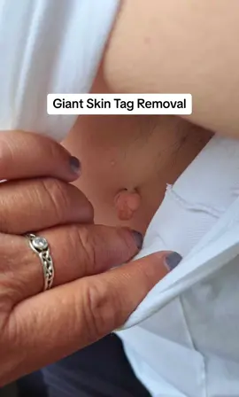 Giant skin tag removal using advanced electrolysis! #skintag #skin #tag #mole #cautery #cauteryprocedure #beforeandafter #procedure #growth #dermatology #dermatologist #electrolysis #blemishremoval #skintagremoval #skinclinic #cosmeticprocedures #medical #skinspecialist #tiktokforbusiness #laser #skin #women #skincarespecialist #aestheticmedicine #dermatology #satisfying