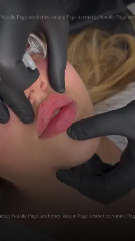 Perfect Your Technique Choosing a practitioner is all about results which is derived from your technique.  Russian lip fillers focus on enhancing the natural shape and proportion of the lips, rather than creating an overly augmented appearance. The technique emphasises a gradual and subtle enhancement, ensuring that the lips maintain a youthful and realistic look. By preserving the innate beauty of one's lips, Russian lip fillers deliver results that seamlessly blend with an individual's overall facial features. ♥ 𝗗𝗠 𝘁𝗼 𝗯𝗼𝗼𝗸 ♥ 𝐰𝐰𝐰.𝐧𝐚𝐭𝐚𝐥𝐢𝐞𝐩𝐚𝐠𝐞𝐚𝐞𝐬𝐭𝐡𝐞𝐭𝐢𝐜𝐬.𝐜𝐨.𝐮𝐤 #3dlips #3dlip #3dimensionallips  #russianlips #russianlips💉#aestheticstrainingcourses #fillertraining #dermalfillertraining #southampton #southamptonmua #russianliptechnique #lipsaugmentation #lipinjections #lipaugmentation  #lipfiller #lipfillersuk #russianliptraining #cupidsbow #fyp #fypage #foryou 