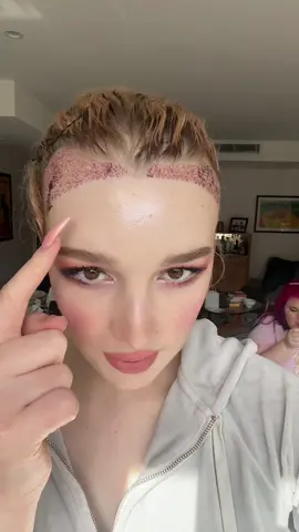 Day 2 of my hair transplant journey 💕