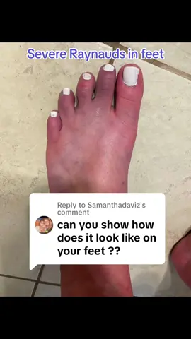 Replying to @Samanthadaviz #severeraynauds #lossofcirculation #painful #numbness #coldsensitivity #fypシ #sahmlife #momtiktok #raynauldssyndrome #coldweather 