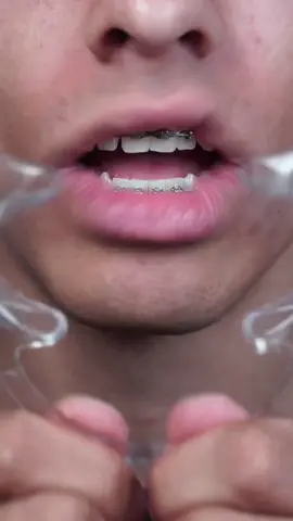 Mr. Beast bars HONEST review 😳 #braces #bracestips #bracesoff #fyp #viral #food #candy #bracescolors #transformation #sour 