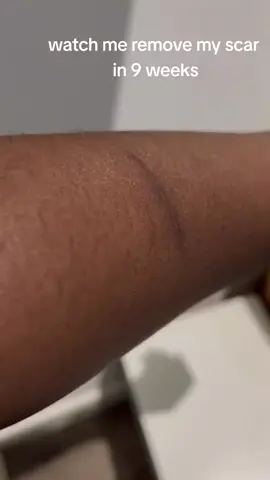 #Effective scar and stretch marks remover# #viral #health #trending #beauty #foxier ... more#ghanatiktokers🇬🇭🇬🇭🇬🇭 
