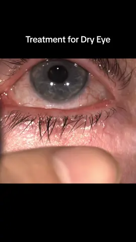 Lots of waxy stuff expressed from meibomian glands. 
