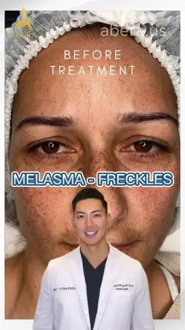 Kasumi Abera Cream - Clean Melasma - White Skin After One Treatment #Kasumiabera #melasma#darkspots#antiaging