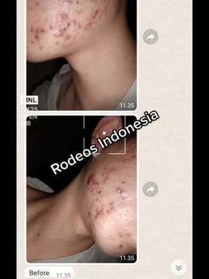 Terima kasih banget rodeos akhirnya saya sudah sembuh dari jerawat, akhirnya membuahkan hasil.