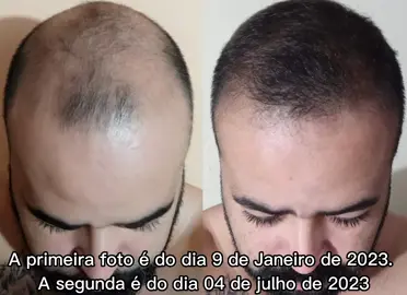 Dutasterida e Minoxidil (antes e depois)  Vídeo pra mostrar um pouco do processo.  Loja que comprei o minoxidil tópico. http://www.barbakirkland.com.br Meu cupom de desconto: mayconvan10 #calvice #finasterida #minoxidil #transplante #dutasterida #capilar #quedadecabelo #calvície #barba #sejaumdoador #cabelo #bearded #ajudaraoproximo #tratamentocapilar #barbeirosbrasil #bigode #soudoadora #microagulhamento #assu #barbados #sejadoador #barbearia #cabeleireiro #viking #barbeiro #pulmão #cabelos #modamasculinastyle #lowfade #doeórgãosdevolvasonhos ---
