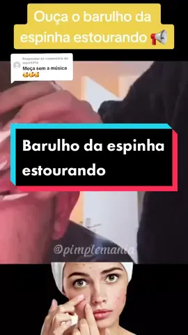 Respondendo a @more5916 mais um barulho de espinha estourando #pimple #squeezy #squeezypip #espinha #espinhasgigantes #acne #skincare 