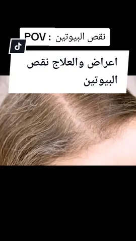 الأعراض والعلاج اذا كان لديك مثل هذه الأعراض فالخلل هو  🔻 نقص فيتامين البيوتين (biotin) 📝 العلاج الإكثار من تناول البيض وخاصه الصفار واللحوم او شراء البيوتين من الصيدلية بعد التحليلات #بيوتين #دوائي 