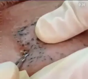 #removalvideo #extractions #satisfying #blackhead 