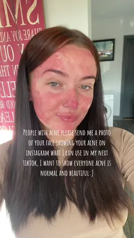 Lets embrace acne🫶🏼🫶🏼🫶🏼 #acnejourney #acne #realskin #acneisnormalandbeautiful 