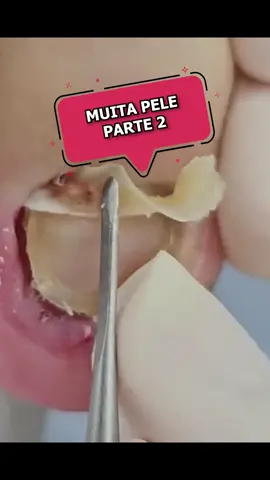 A parte dois do classico de muita pele.. #unhasencravadas #ingrowntoenail #ingrowntoenailremoval #unhaencravada #uñaencarnada #longervideos 
