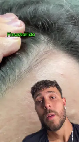 ACHOU A CURA DA CALVÍCIE