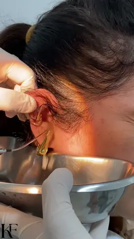 Escutar o mundo com clareza é essencial!  👂💧 A lavagem de ouvido é mais do que um cuidado, é uma maneira de garantir que todos os sons cheguem até você em alta definição.  Cuide da sua audição, cuide de você!  #CuidadosComAAudição #SaúdeDosOuvidos #lavagemdeouvido #otorrinolaringologista 