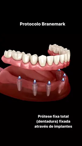 Prótese frouxa nunca mais  Conheca o protocolo Branemark: ✅ estética ✅ conforto ✅ eficiência mastigatória ✅ estabilidade ✅ segurança #dentadura #protesedentaria #implantedental 