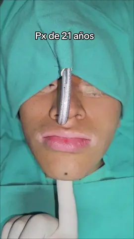 CIRUGÍA ORTOGNÁTICA MÍNIMAMENTE INVASIVA - Alta médica en 12 hrs - Planificación Virtual en 3D Tarija - Bolivia 🇮🇩  #cirugiaortognatica #cirugiamaxilar #fypシ #viral #odontologia #ortognatica #maxilar 