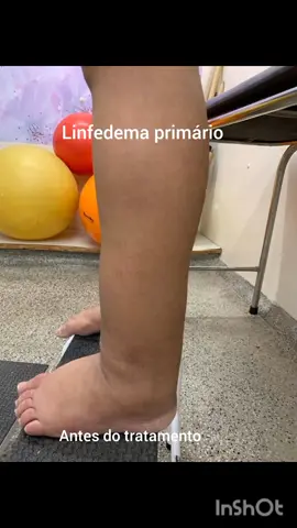 parte 1/2 eu explico melhor no próximo vídeo. Não é fácil ter que lidar com uma doença crônica! #oncologia #linfedemaprimario #tiktok 