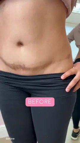 Check out these amazing scar lightening results!✨🫶🏻 To read more abour the procedure, head over to our Instagram!  #inklesstechnique #inklesscamouflage #inklessscarcamouflage #inklessscarlightening 