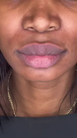 Follow one of our patients on their laser lip pigmentation journey 🤩 #fyp #laser #hyperpigmentation #london #skincare #clinic #skincaretips 