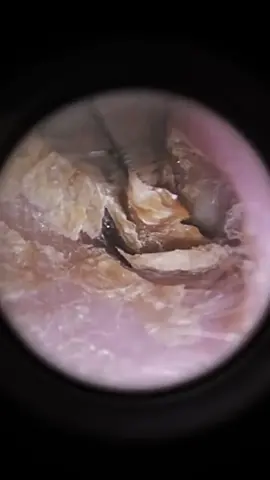 Guess how long it’s been since his ears were cleaned ?#ear #earwax #earwaxremoval #earwaxcleaning #earwaxremmoval #earwaximpaction #satisfying #relax #relaxing #relaxingvideos #foryou #fpyシ #fpy 