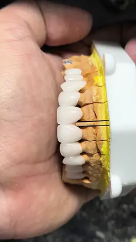 Lâu lắm mới đụng vào thẩm mỹ #răng_sứ_thẩm_mỹ #form_răng_tự_nhiên #nature 