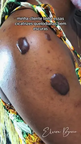 Se você curtiu esse trabalho, segue meu perfil na rede vizinha e compartilha 🫶 #queloide #keloid #scartattoo #scartattoocoverup #coberturadecicatriz #cicatriz #autoestima #pelepretatatuada #darkskintattoo #DiaDosPais #elvirabono #tatuagem #tattoo #tattooartist #tiktokbrasil 