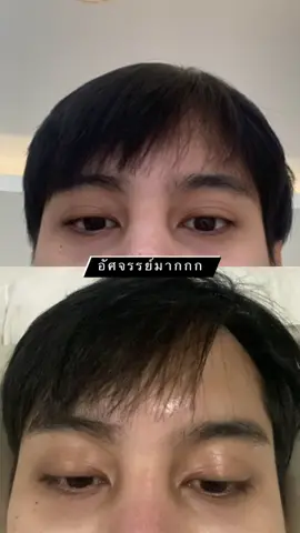 ✨ วงการใต้ตาคล้ำ เข้าเเล้วออกได้ ! ด้วยโปรแกรมฟิลเลอร์ที่เหมาะสมกับการเติมใต้ตา ไม่เป็นก้อน เพิ่มมิติให้หน้าดูสดใส ไม่โทรม ฉีดโดยคุณหมอประสบการณ์แน่นทุกเคส ! . 👉🏻 #รีวิวจากลูกค้าจริง นึกถึงความสวยต้อง #เอเมริส เลยค่าา #ใต้ตาคล้ำ #ฟิลเลอร์ #ฉีดฟิลเลอร์ #ฉีดฟิลเลอร์ที่ไหนดี #fillers #aimeris 