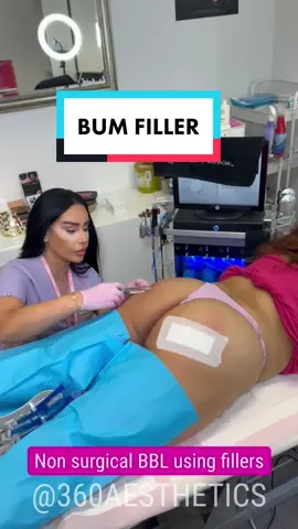Bum filler 🍑💉 #bbl #bumfiller #bumfilleruk #bumfillerinjection #bumfillerssouthkensington #bumfillereastlondon #liquidbbl #sculptra #lanluma #hyacorp #hyacorpbody #hyacorpfiller #hyacorpbbl #bbltraining #fy #fypシ゚viral 