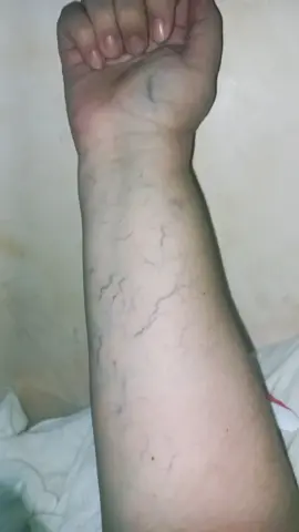e eu que tenho varizes no braço!!! isso mesmo no braço! e mais louco ainda... NASCI ASSIM, queria muito saber o motivo e saber se teria como tirar, eu escondi meu braço a infância toda com vergonha por achar 