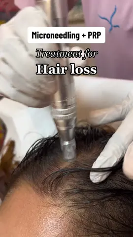 Followed by Microneedling, we also inject the PRP with growth factors into the scalp. Requires 3-4 sessions for best results #fypシ #prp #hairloss #treatment #dermatologist #shirapa 