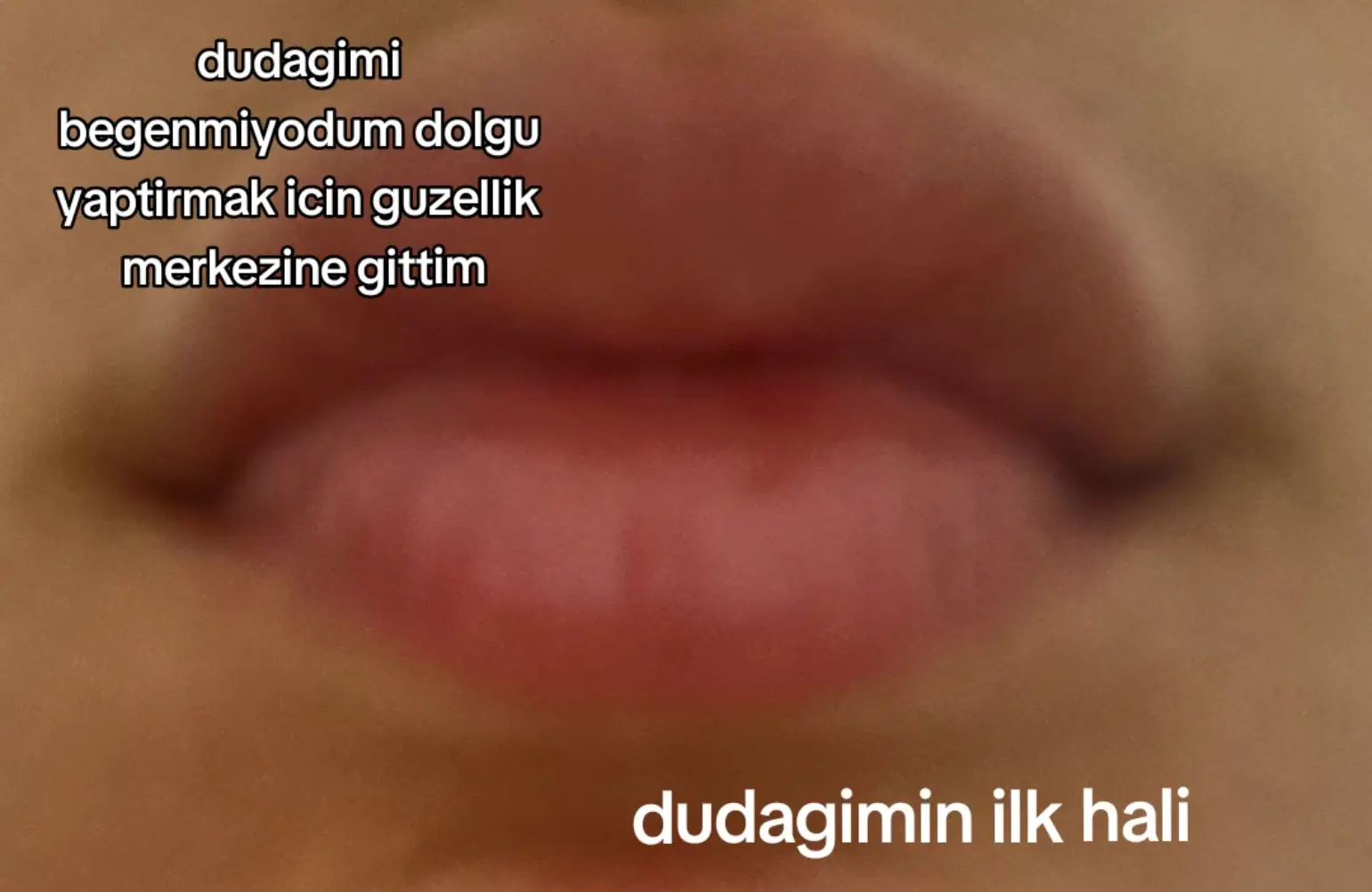 allah o doktorun belasını versin dudagimin ilk hali o kadar da kötü değilmis ama insanlar dalga geciyodu sürekli bende yaptirdim keske yaptirmasayadim #facia #felaket #esmakosiko 