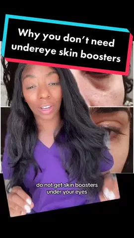 I love skin boosters such as Lumi Eyes, Sunekos and Jalupro but they may not be right for you! If you have puffy eyes youre actually signing up to have WORSE puffiness if you get skin boosters under the eyes. So just trust me on this one and dont do it! #skinboosters #lumieyes #darkcircles #sunekos #injectables #BeautyTok #skincare #puffyeyes 