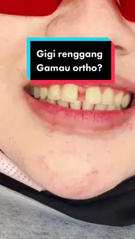 60 menit aja byebye gigi renggang..  Kasus kali ini dikerjain langsung dokter gigi aku di @Klinik Gigi Terbaik drg @M Taufik Hidayat ✌🏻