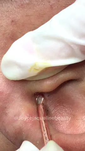 Cravinhosss na orelhaaa #cravolovers #satisfatóriosvideos #fy #poppingpimples #videosatisfatorio #tirandocravo 