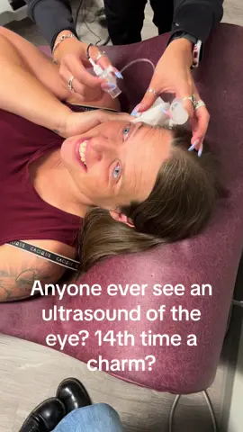 They did this 14 times. My myopia is ao bad they couldn’t get a reading. Doctor finally had to stop appointments and come do it. 5 more times from him and they finally got a read. #cataract #donnaibarrowsyndrome #blindness #menieresdisease #pcoswarriors #eyeultrasound #prostheticeye #fyp 