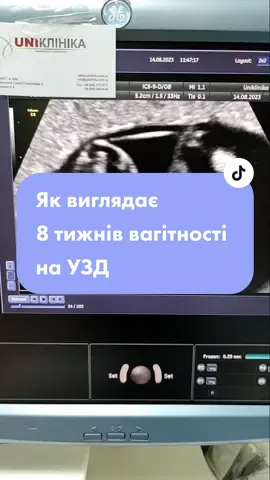 #уздвагітність #8тижнів  #вагітність🤰 #уздмалоготаза #гінекологія #уздматки #уздкиїв #узд #уздгінекологія #пузожитель 