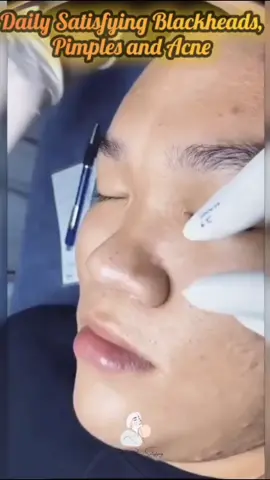 #pimplepoppersatisfying #pimple #blackhead 