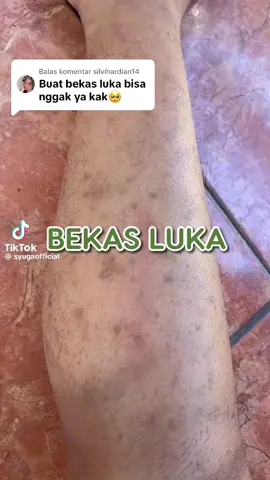 Membalas @silvihardian14 bekas luka pkai ini ya kak aku tarih di kranjang kuning produk nya kalau mau beli🥰🥰#syuga #syugaminyakzaitun #bekasluka 