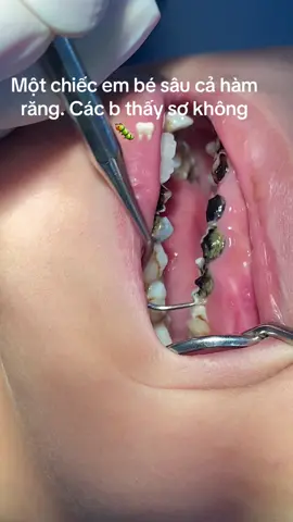 Sâu răng gây đau nhức ảnh hưởng đến chức năng ăn nhai của trẻ. Do thói quen ăn cơm ngậm ,uống sữa đêm vệ sinh răng miệng kém. Phụ huynh chú ý đến cách vệ sinh răng miệng của bé nhé #saurang #viemtuy 