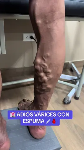 🏩 TRATAMIENTO DE VÁRICES CON ESPUMA DE POLIDOCANOL 💉🩸 Ideal en pacientes NO QUIRÚRGICOS , con ecografía Doppler con safenas competentes o ya operados ☺️🤝 Sin Cortes , Sin Cicatrices, Sin Hospitalización 💪 📲 +593995178395 #cristianbravo148 #varices #varicesyarañitas #varicesenlaspiernas #varicesgrandes #varicesgoodbye #varicesyarañitas😐🥺 #varicesenelembarazo #mujeresaludables #saludecuador #cirugiavascular 