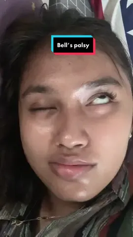 Hi… Kenalin ini dia. Aku sudah 5 minggu  menjadi penderita bell’s palsy,karna dari hari ke hari,minggu ke minggu rasanya cukup berat namun perubahan untuk sembuh pun sdh cukup terlihat ,walau sampai saat ini pendengaran ku malah menjadi sensitif dan beberapa aktifitas yg aku lakukan menjadi terganggu, Dari aku yg banyak nangisnya sampai aku bisa belajar untuk bisa berusaha ikhlas  ngejalanin nya  Apapun yg aku jalani,meskipun sakit akan aku tetep lakukan supaya aku sembuh❤️‍🩹💖 #foruyoupage  #bellspalsy #bellspalsyrecovery 