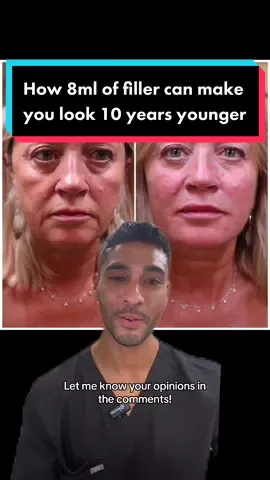 This is how 8ml of filler can make you look 10 years younger #filler #antiageing #10yearsyounger #fillertok #antiaging #drdevine #beforeandafter #beforeandafterfiller #fillerpackage 