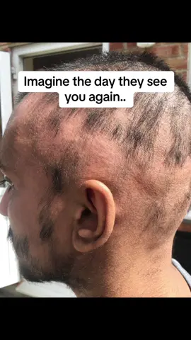 The Doctors didn’t think my hair could ever grow back. I proved them all wrong by using hair oil and having Hope!❤️🔥 #hairoil #hairloss #beforeandafterhair #hairtransformation #sabrremedies #hairgrowthtips #alopecia 