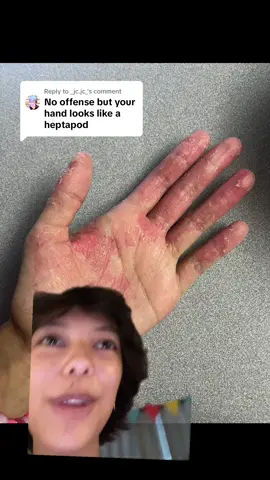 Replying to @_jc.jc_ the minotity was peeling away #greenscreen #eczema 