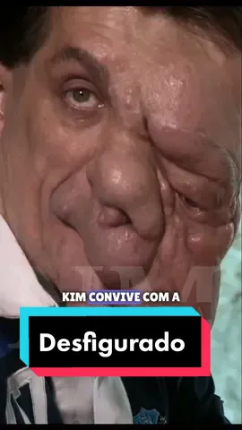 Ele teve seu rosto desfigurado. #historiasemocionantes #historias #casosreais #fatosreais 
