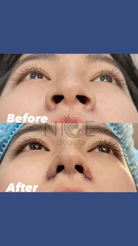 Đâu phải ai cũng thích nâng mũi đâu, với sóng mũi cao như vậy chỉ cần thu cánh nũi là ổn rồi #cuộncánhmũi #cắtcánhmũi #nicebeauty_since2016 #phuongkhanhtm 