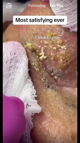 #noseextractions #whiteheadremoval #whiteheads #skincare #satisfying #pimplepop #foryou #viralvideo 