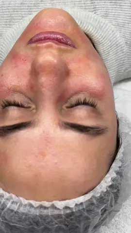 ¿Que es el Dermapen, como funciona y que beneficios da a la piel? #foryou #parati #dermapen 