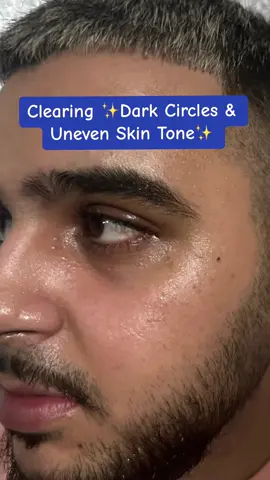 If you struggle with dark circles, uneven skin & dullness ~ these 2 products will change your skin care routine!✨❤️ #foryoupage #foryou #trending #acne #acneskin #skin #skincare #clearskin #hyperpigmentationtreatment #desi 